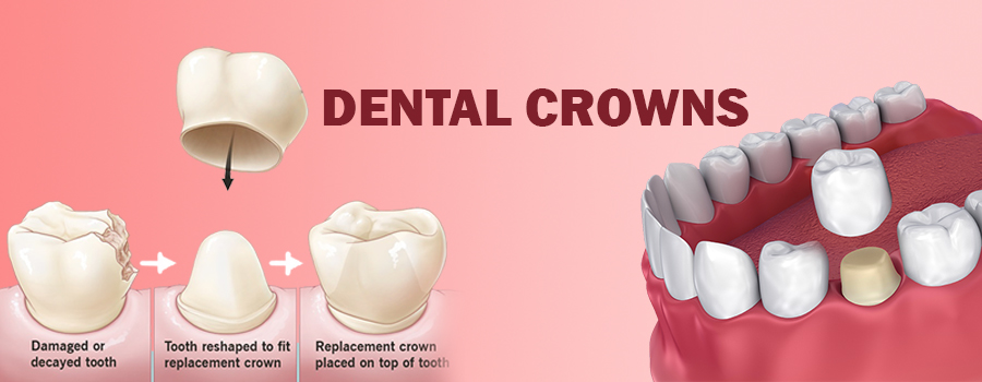 Dental_crowns_app_banner_1626685794_banner_1645702626.jpg
