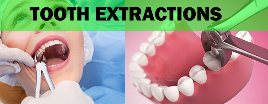 Tooth_extractions_app_banner_1626686344_banner_1645705292.jpg