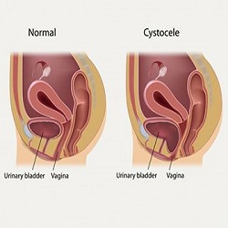 Anterior prolapse (cystocele)