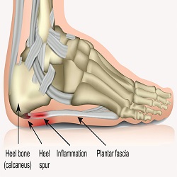 Foot Pain and Problems