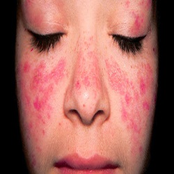 Systemic Lupus Erythematosus (Lupus)