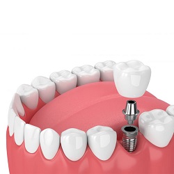 Dental Implants