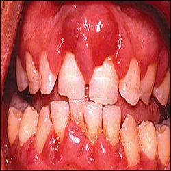 Oral Swelling