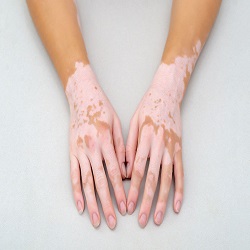 Vitiligo