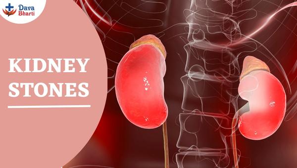 Kidney Stones : Causes, Symptoms & Treatment