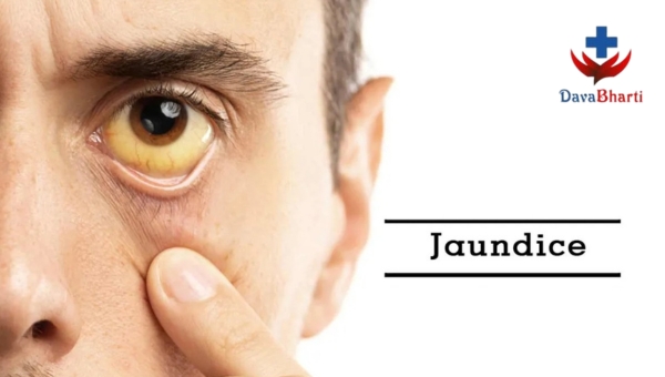 Jaundice: Causes, Symptoms, and Treatment