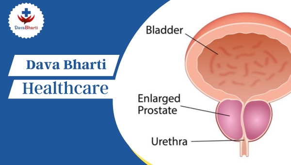 Benign Prostatic Hyperplasia Benign Prostatic Hyperplasia